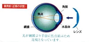 オルソケラトロジーの仕組み2