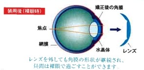 オルソケラトロジーの仕組み4
