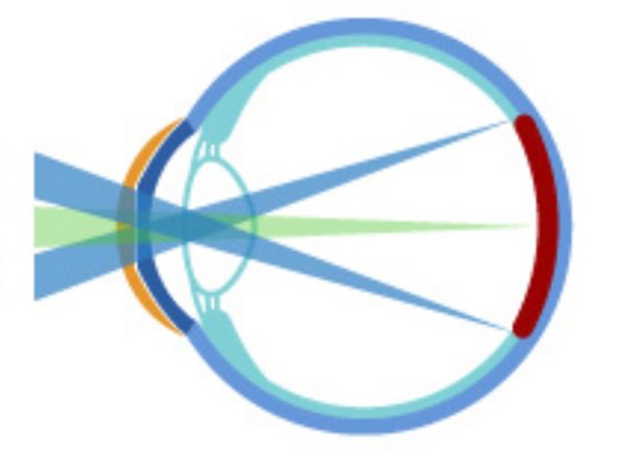 オルソケラトロジーの場合