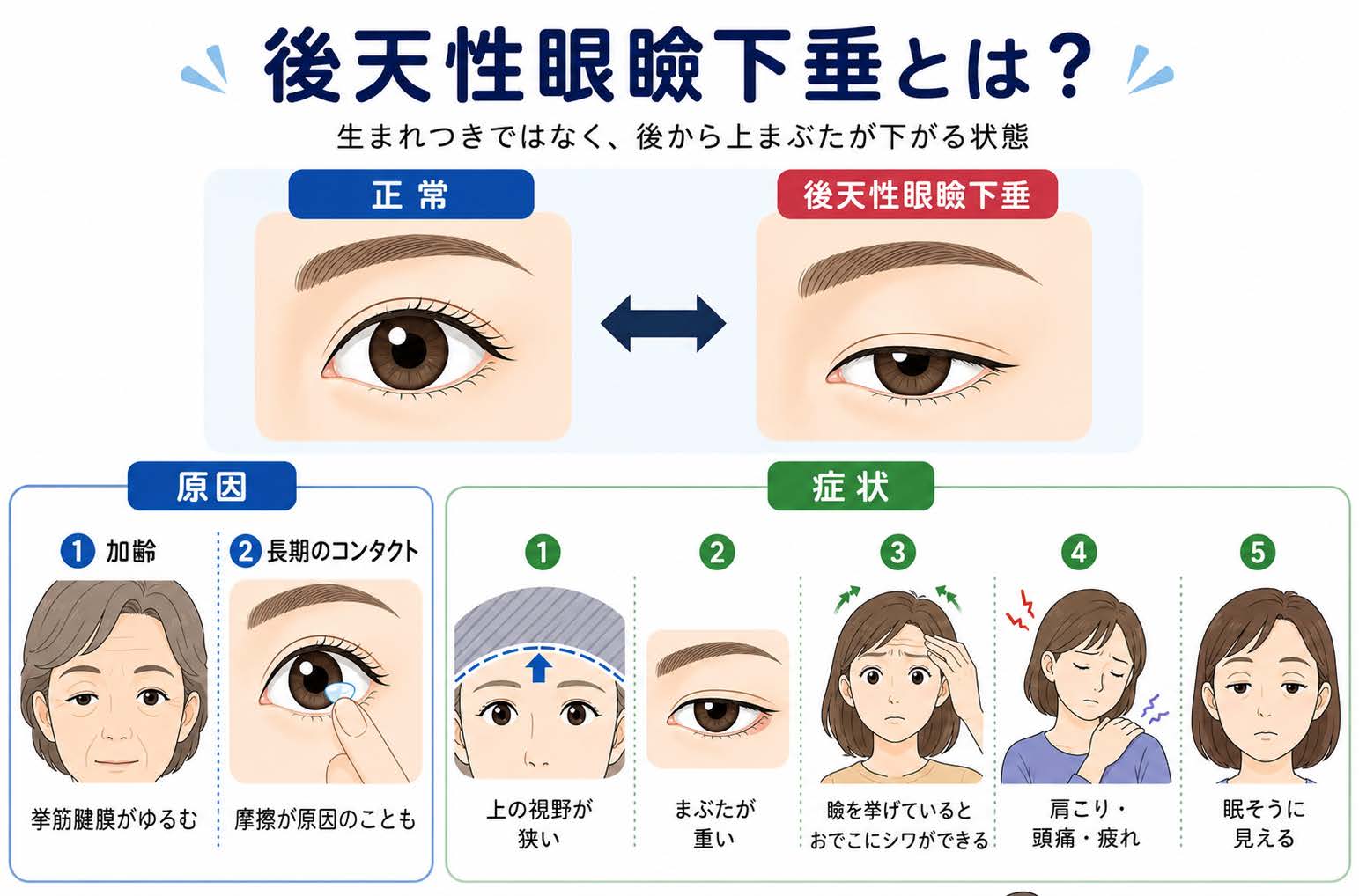 後天性眼瞼下垂とは？